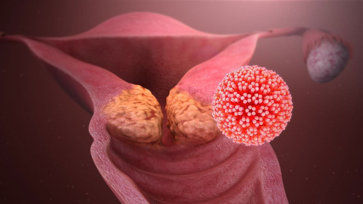 Vajinal Siğil (HPV Virüsü) Nasıl Tedavi Edilir? kapak resmi